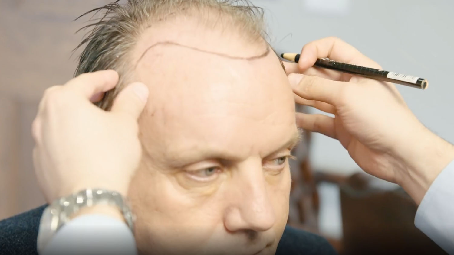 Hair transplant diary - The D’Souza Clinic